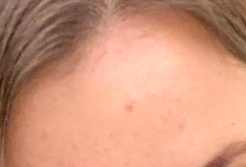 How long will it take for acne scars to go?