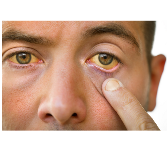 Jaundice skin