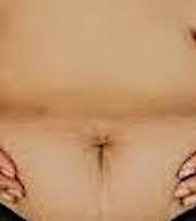 Why do overweight people get skin darkening in skin folds?
