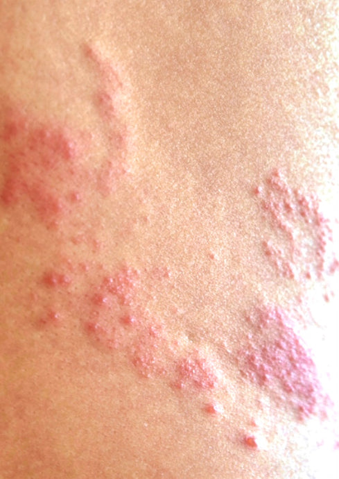 How do I cure shingles with coconut oil?