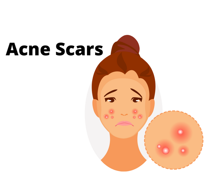 Customer Question:How long will acne scars take to go?