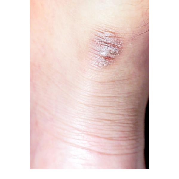 Blistered skin