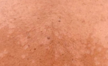 What is the proper treatment for tinea versicolor?