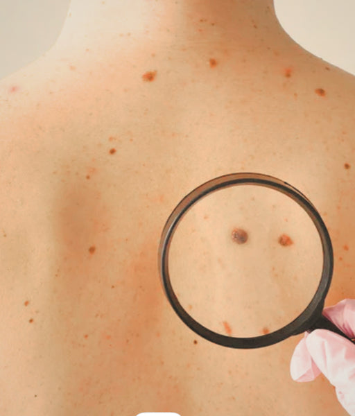 What are the different types of skin cancer?