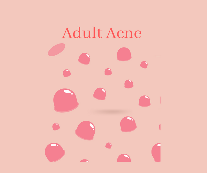 How can I treat adult acne - I have tried benzoyl peroxide and salicylic acid and suffer from PCOS.